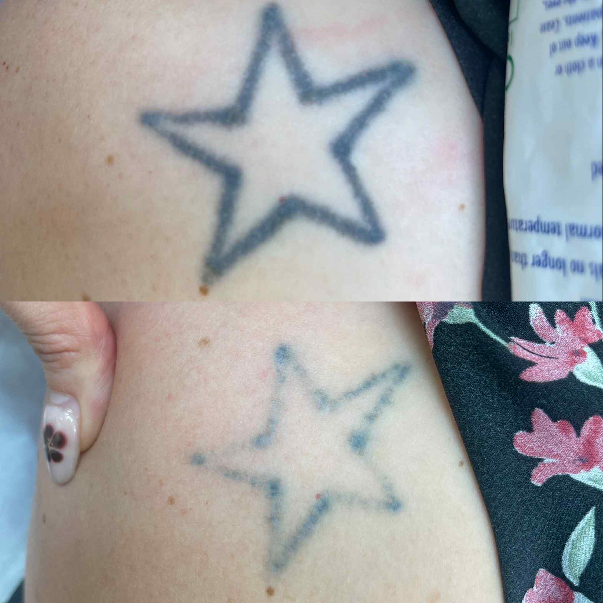 Removal Treatment Results